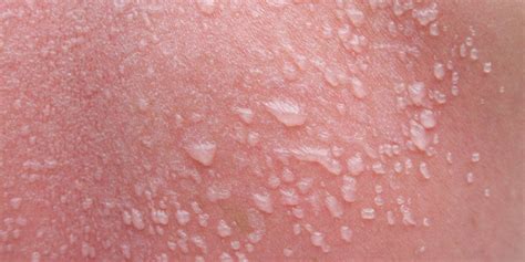 Sun Blisters: How to Treat Them and How Long They Last